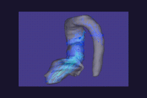 大動脈二尖弁の患者様の大動脈 4D flow．二尖弁では，上行大動脈内に螺旋流が生じており，その後の動脈拡大や瘤形成との関連が示唆される．