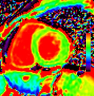心筋T1値計測．反転回復法を用いるMOLLI法が主に用いられるが，飽和回復法の一つである SMART1Map法も利用可能である．飽和回復法は反転回復法に比べて計測結果のばらつきが大きいが，より真値に近い結果が得られると考えられている．